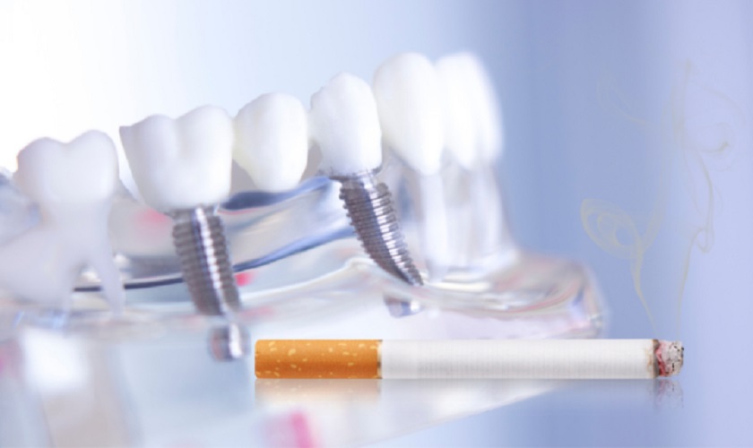 Hút thuốc lá ảnh hưởng tới phương pháp trồng răng Implant như thế nào?