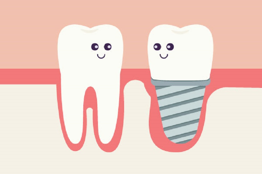 Răng Implant tồn tại độc lập không xâm lấn đến các răng khác