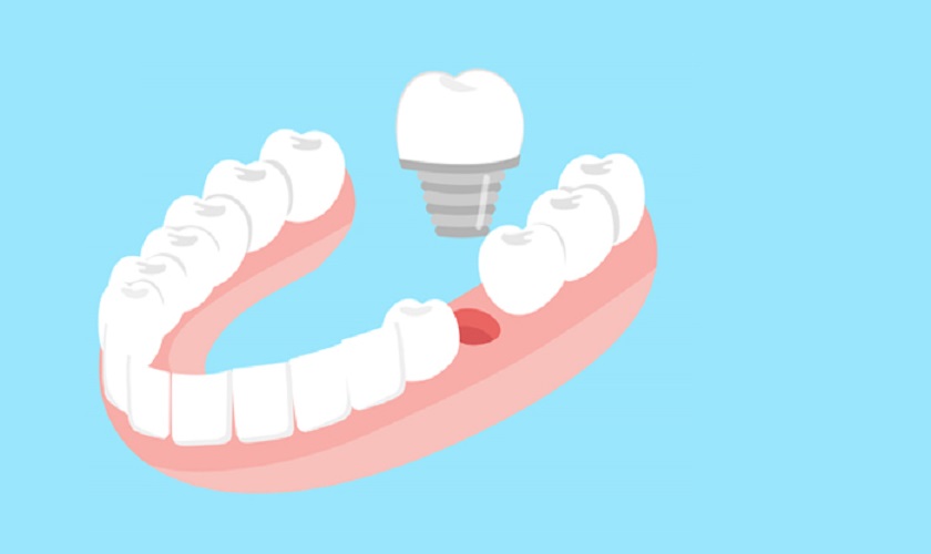 Trồng răng Implant là sao? Khi nào nên áp dụng?