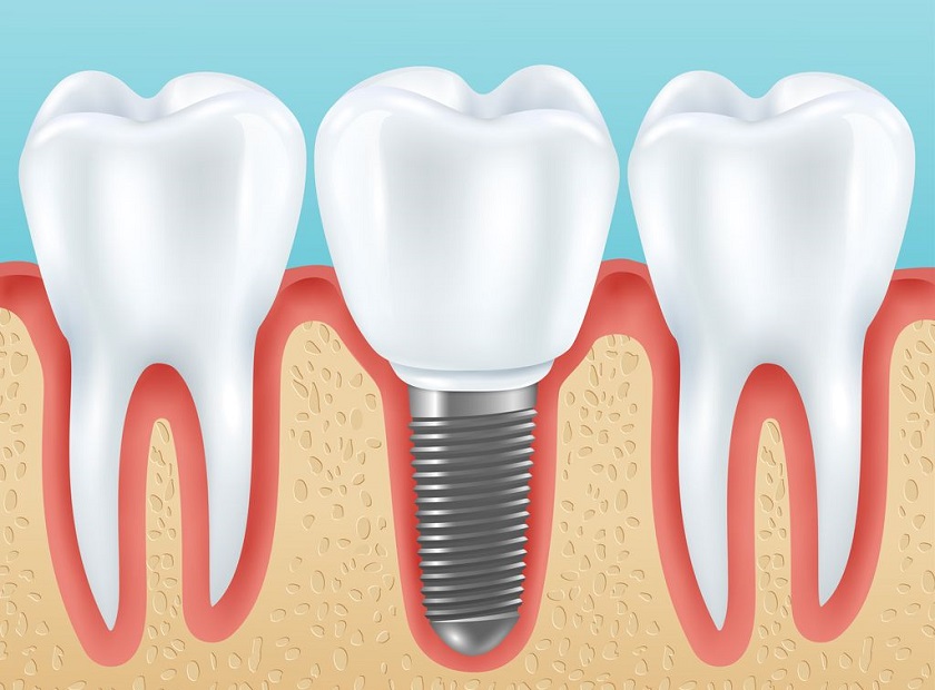 Trồng răng Implant mất bao lâu tại Nha Khoa Nhân Tâm