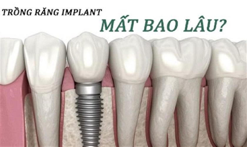 Trồng răng Implant mất thời gian bao lâu?