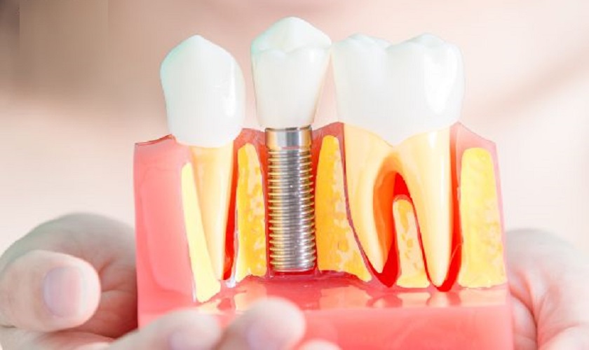Trồng răng Implant Mỹ có tốt không? Chi phí bao nhiêu?