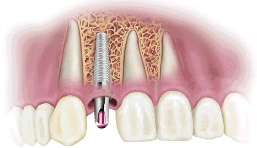 Trồng răng Implant – kỹ thuật phục hình răng hiện đại nhất