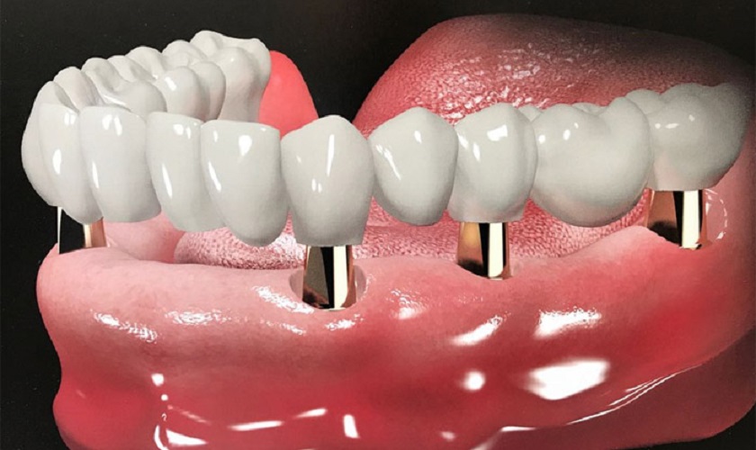 Những tiêu chí quyết định nha khoa trồng răng Implant uy tín