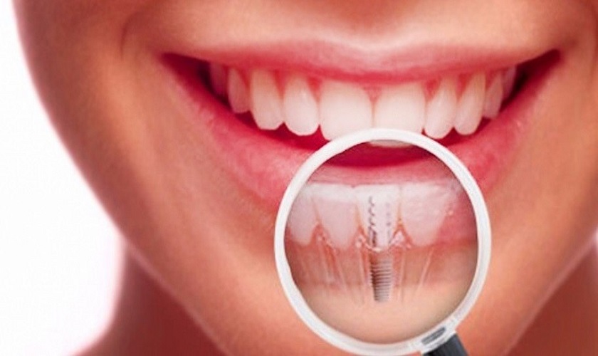 Trồng răng Implant rẻ nhất, hiệu quả nhất tại TPHCM