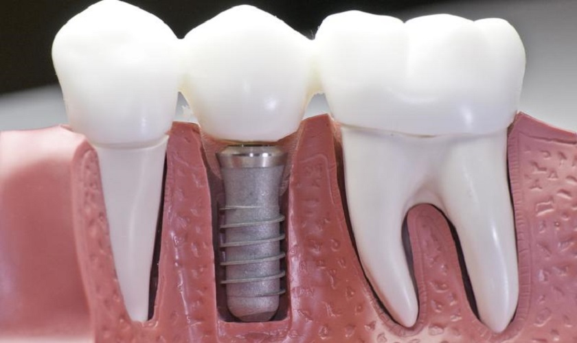 Loại implant nào tốt để trồng răng số 6