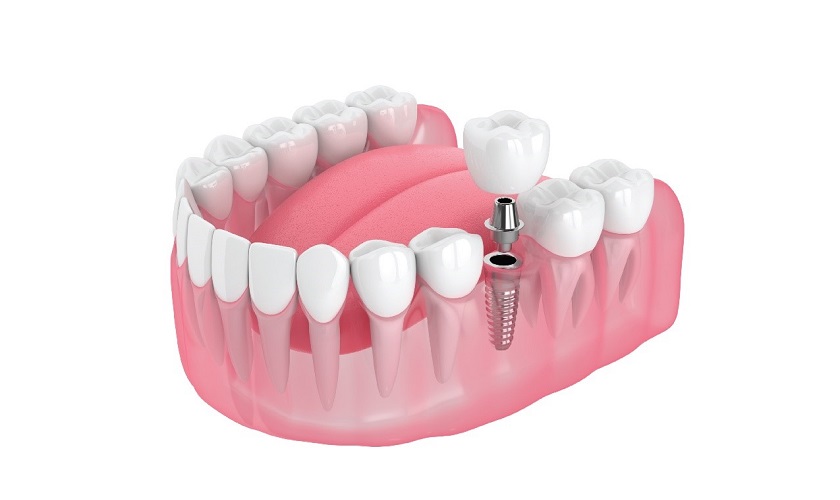 Ưu điểm và một số lưu ý khi trồng răng implant số 6