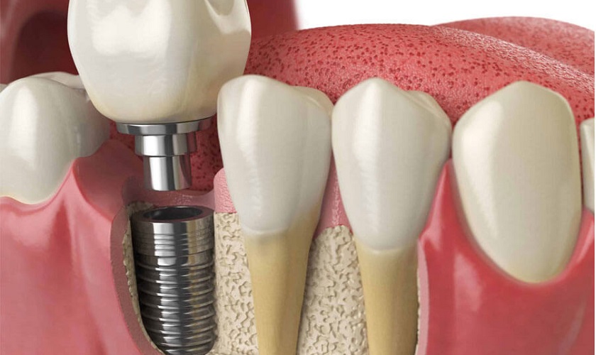 Trồng răng implant số 6 bao nhiêu tiền?
