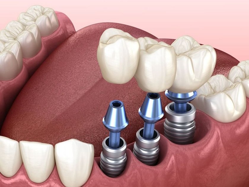 Trồng răng giả vĩnh viễn bằng cấy Implant