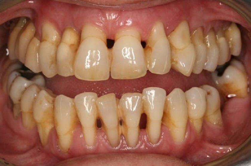 Hình ảnh hàm răng của người bị tụt lợi