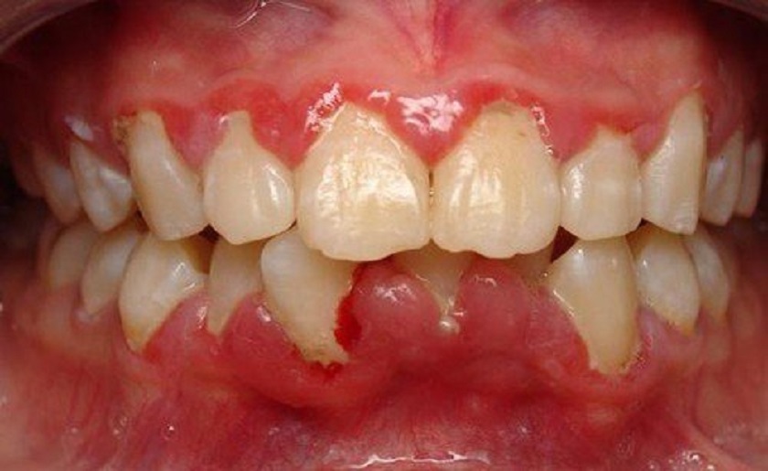 Viêm nướu lâu ngày có thể dẫn đến tụt nướu chân răng