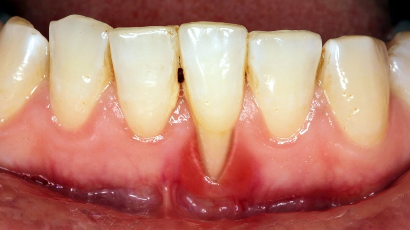 Khi bị tụt nướu bạn sẽ thấy nướu răng teo dần, tụt xuống làm chân răng lộ ra ngày càng nhiều