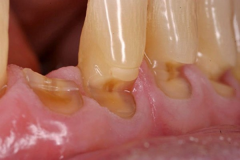 Nguy cơ mất răng vĩnh viễn hoàn toàn có thể xảy đến nếu không chữa trị tụt lợi chân răng kịp thời