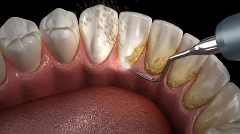 Cạo vôi răng là biện pháp điều trị nướu bị tụt thường được chỉ định