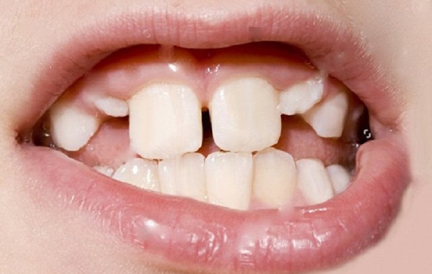 Răng thiếu canxi có thể bị mọc chậm, mọc nghiêng, không thẳng hàng