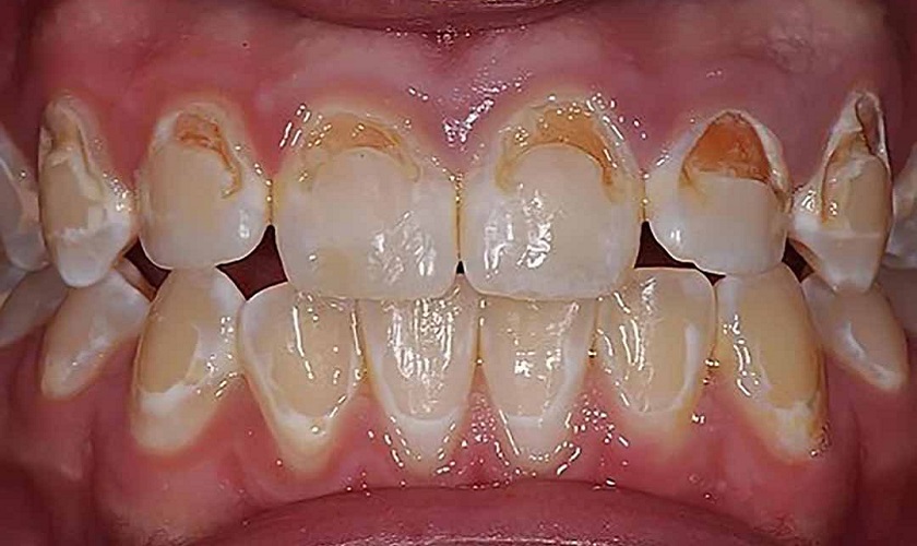 Hình ảnh hàm răng bị ố vàng ở người thiếu canxi