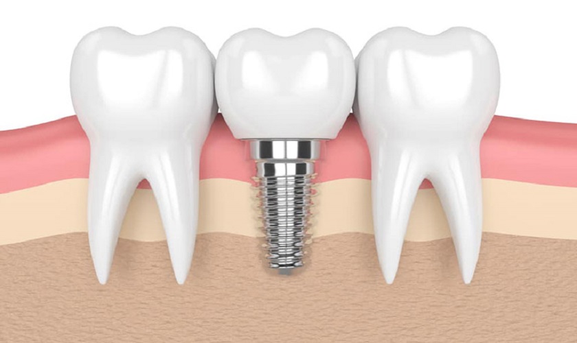 Trồng răng Implant – biện pháp phục hình răng mất tiên tiến nhất hiện nay