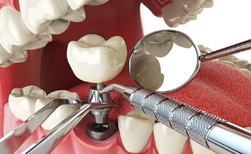 Quá trình cấy ghép không xâm lấn đến các răng khác trên cung hàm
