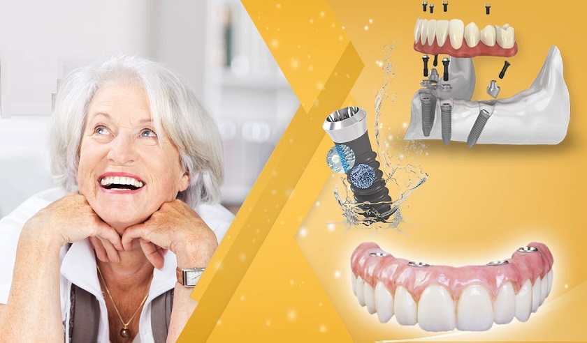 Trồng răng Implant toàn hàm giúp khôi phục thẩm mỹ và chức năng ăn nhai