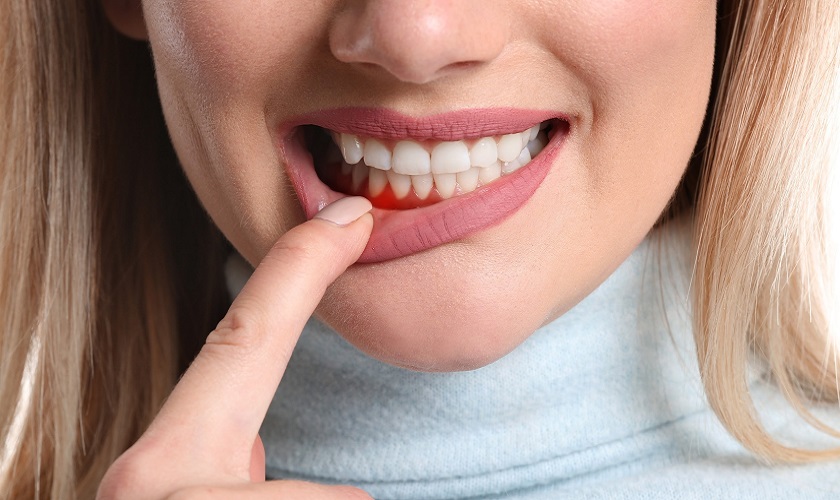 Vệ sinh răng Implant toàn hàm đúng cách giúp ngăn chặn viêm nha chu