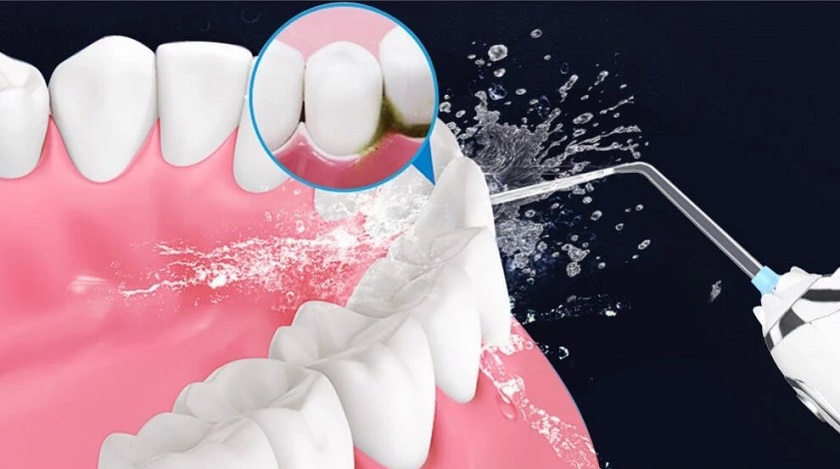 Nên sử dụng máy tăm nước để vệ sinh răng Implant hàng ngày