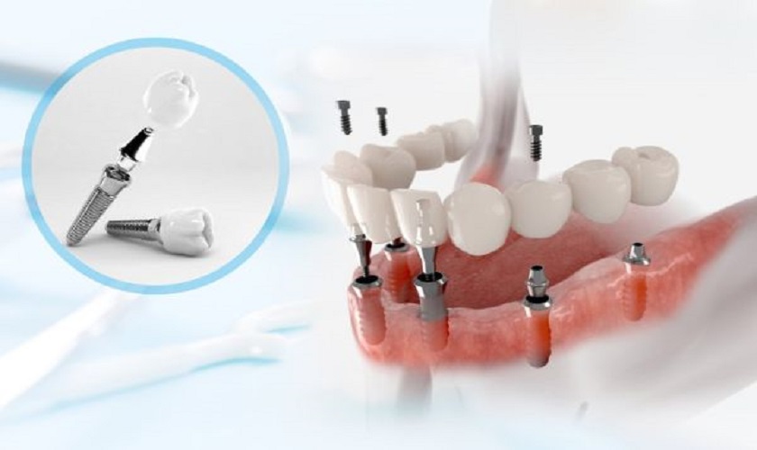 Chia sẻ cách vệ sinh răng Implant toàn hàm chuẩn nha khoa