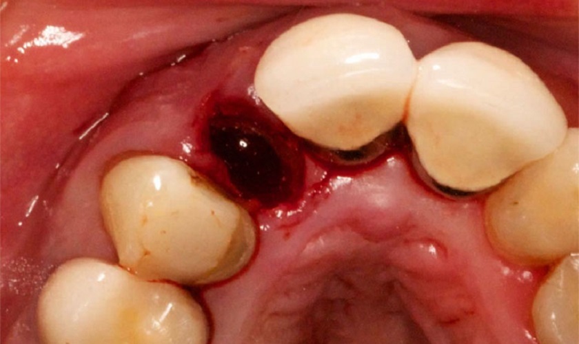 Viêm huyệt ổ răng là gì? Nguyên nhân và cách điều trị