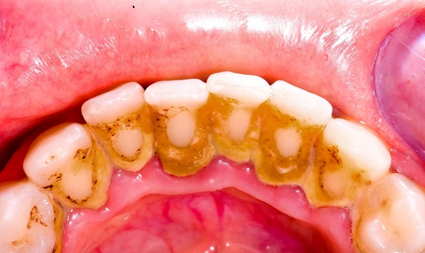 Vôi răng (Cao răng) là gì? Có nên lấy vôi răng thường xuyên?