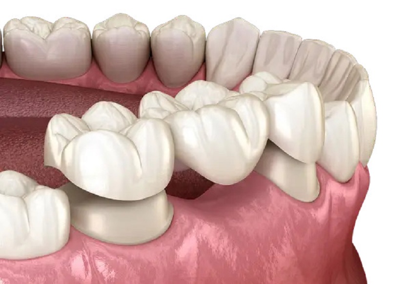 Phục hình răng mất với biện pháp bắc cầu răng sứ