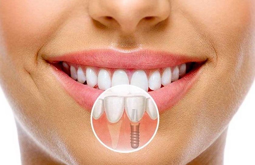 Cấy ghép răng Implant mang lại thẩm mỹ tối ưu
