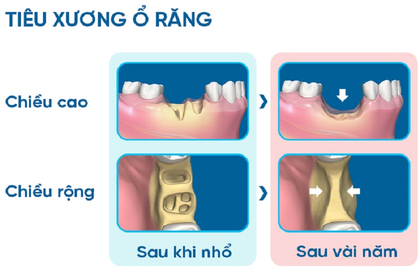Tiêu xương là biến chứng nguy hiểm xảy ra sau thời gian dài mất răng