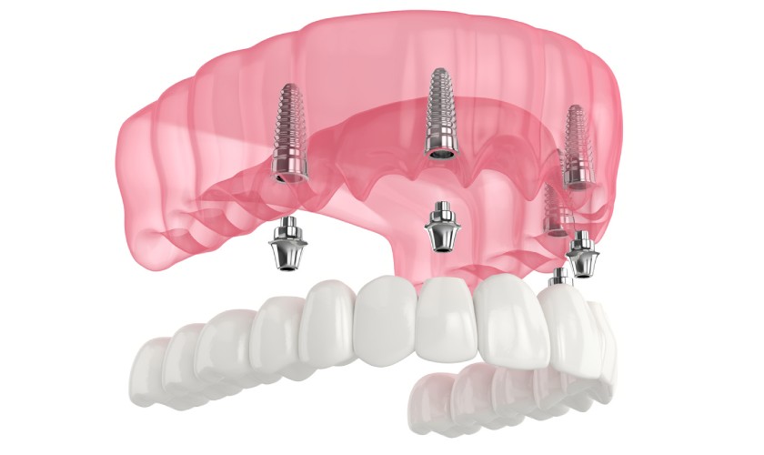 Implant All on X là phương án trồng răng tiết kiệm với người bị mất toàn bộ hàm răng