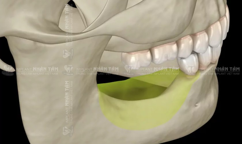 Trồng răng Implant trễ có thể gặp phải tình trạng tiêu xương