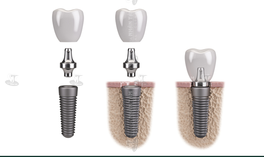 Trụ Implant Osstem tích hợp xương nhanh chóng