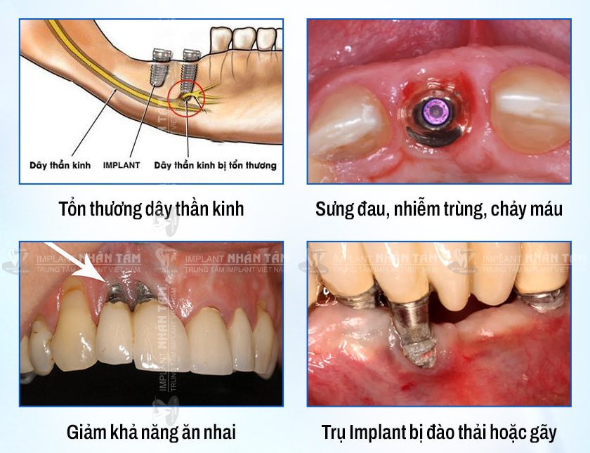 Biến chứng nguy hiểm khi trồng răng Implant