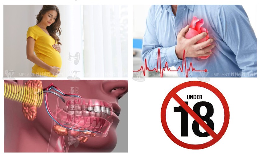 Những trường hợp chống chỉ định tuyệt đối khi trồng răng Implant