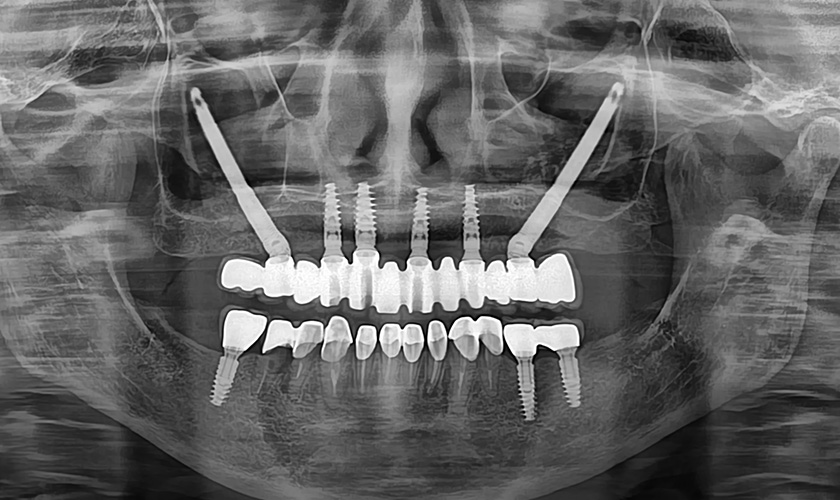 Ảnh chụp X-quang 2 implant xương gò má ở vùng răng sau và 4 implant thông thường ở vùng răng trước