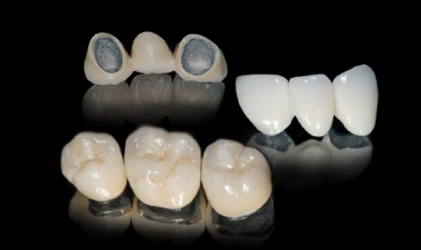Sản phẩm răng sứ kim loại thường có tuổi thọ ở mức trung bình