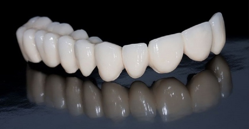 Sản phẩm răng toàn sứ cao cấp với độ bền chắc cao và tuổi thọ lâu dài