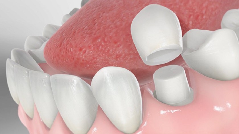 Đa phần các trường hợp bị hỏng răng sứ cần phải thay mới hoàn toàn