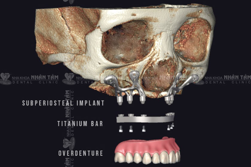 Cấy ghép Implant cá nhân hóa được áp dụng cho bệnh nhân phẫu thuật cắt bỏ đoạn xương hàm