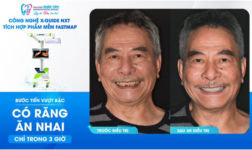 X-Guide thế hệ mới tích hợp Fastmap giúp khách hàng có răng chỉ trong 3 giờ.