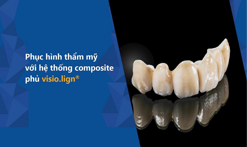 Ứng dụng hệ thống composite phủ visio.lign® làm răng thẩm mỹ