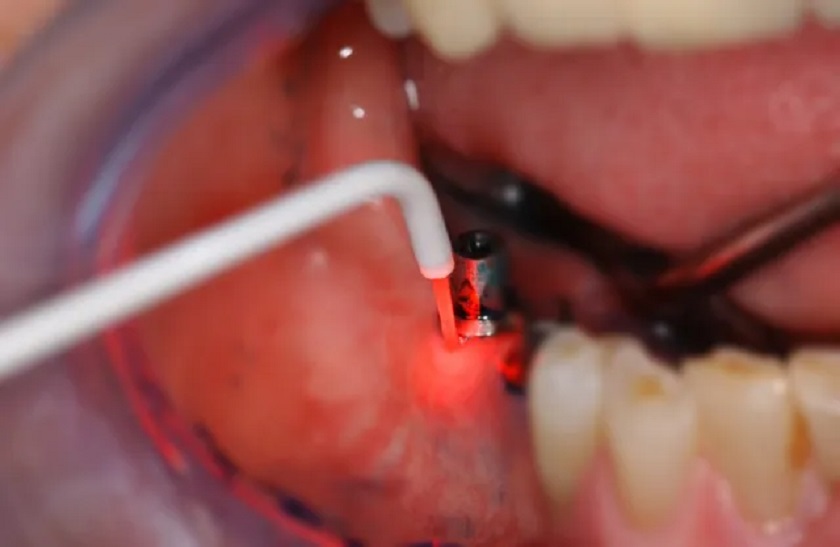 Ứng dụng liệu pháp quang động laser Helbo trong trồng răng Implant
