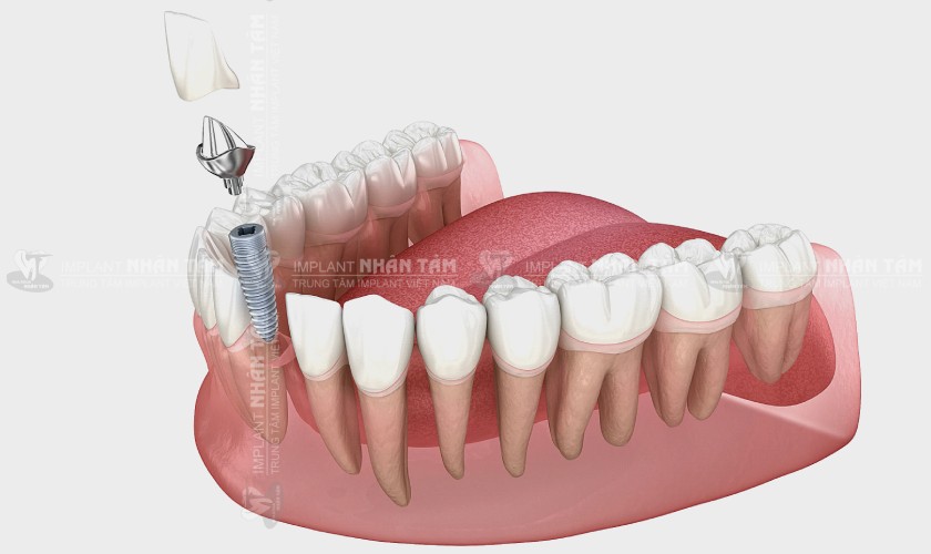 Trồng răng Implant sau 4 đến 8 tuần mang đến nhiều ưu điểm