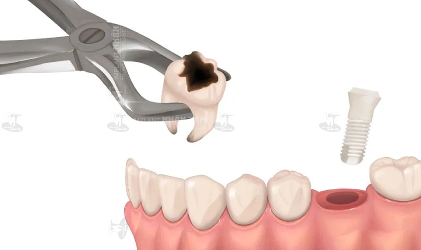 Nên cắm Implant ngay sau khi mất răng