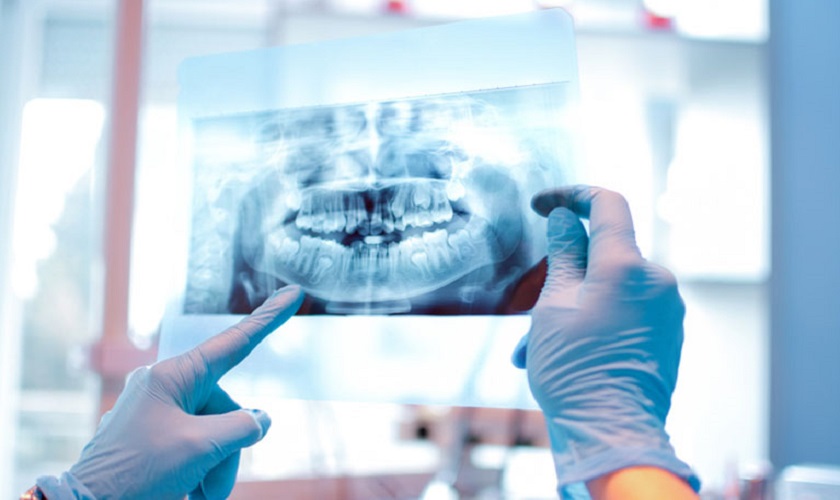 Vai trò của chụp X quang răng toàn cảnh trong điều trị nha khoa