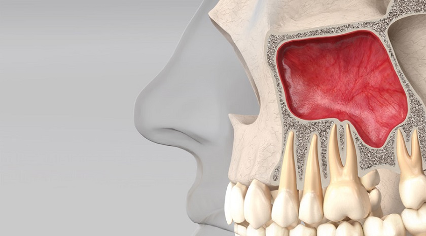 Viêm xoang hàm do răng là một trong những bệnh lý về viêm xoang hàm thường gặp
