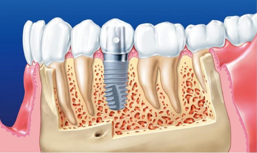 Trồng răng Implant rất hiếm khi gây ra viêm xoang hàm