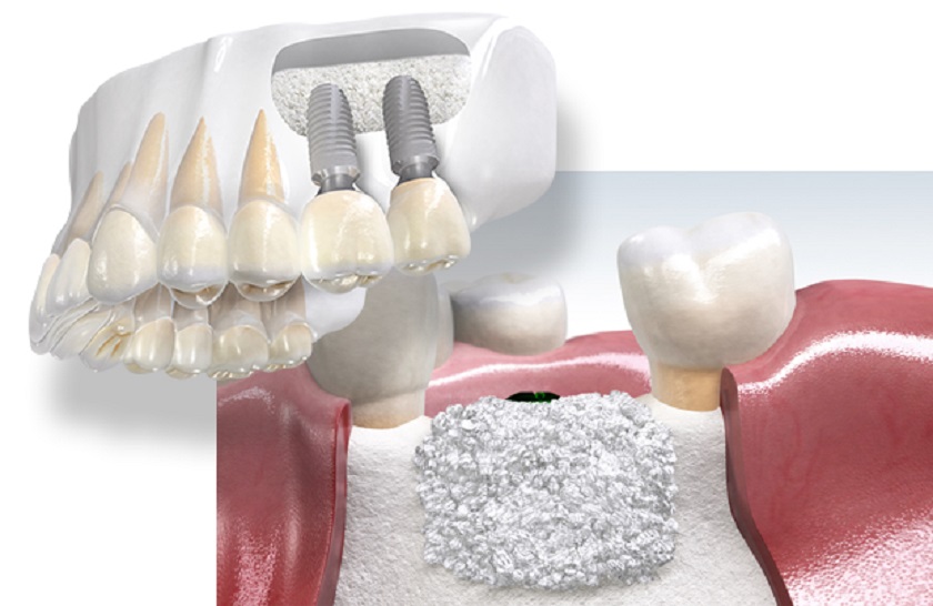 Ghép xương giúp ngăn chặn chân răng nhân tạo đâm vào vách xoang và gây viêm xoang